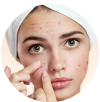 acne-spot-pimple-2.png